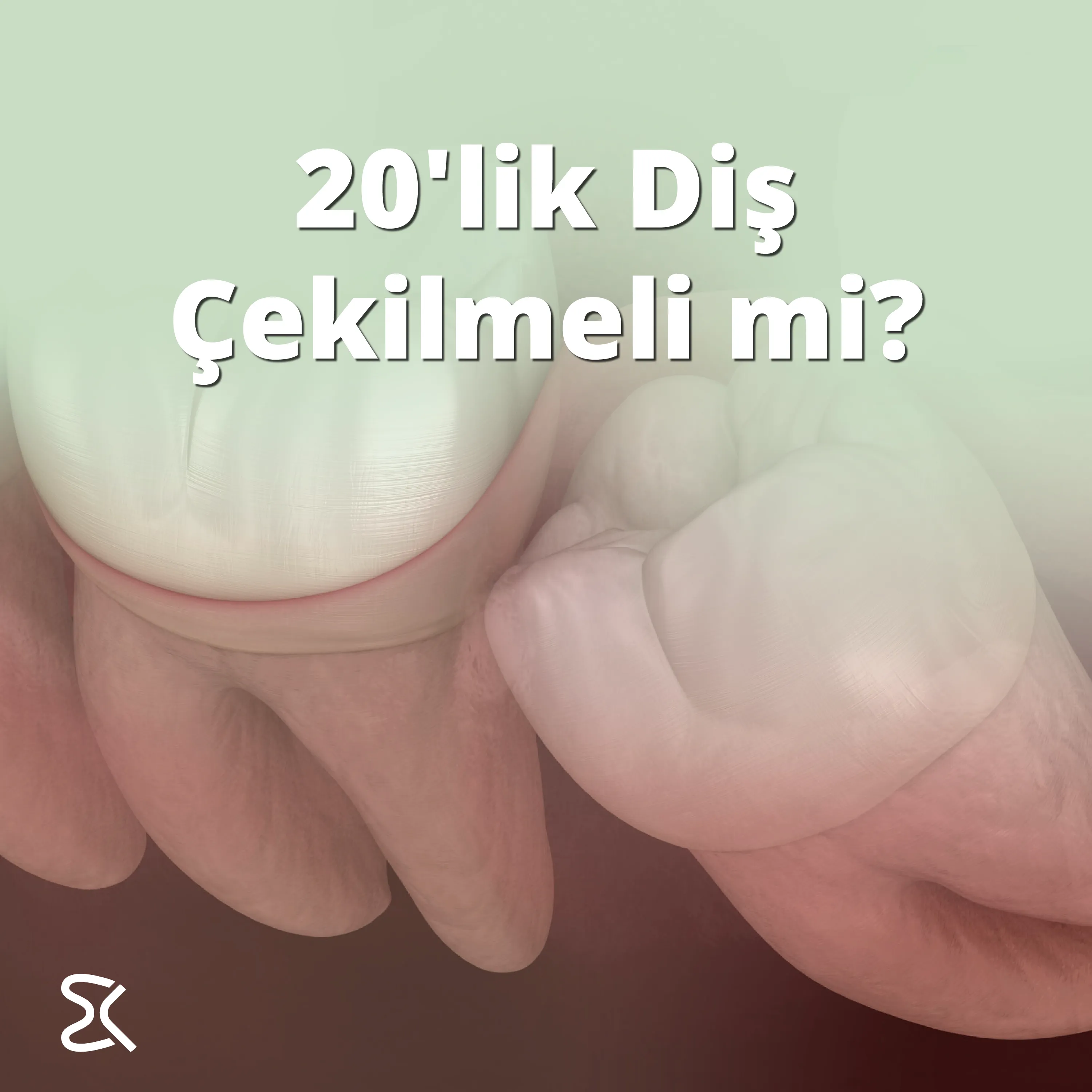 20'lik Diş Çekilmeli mi?