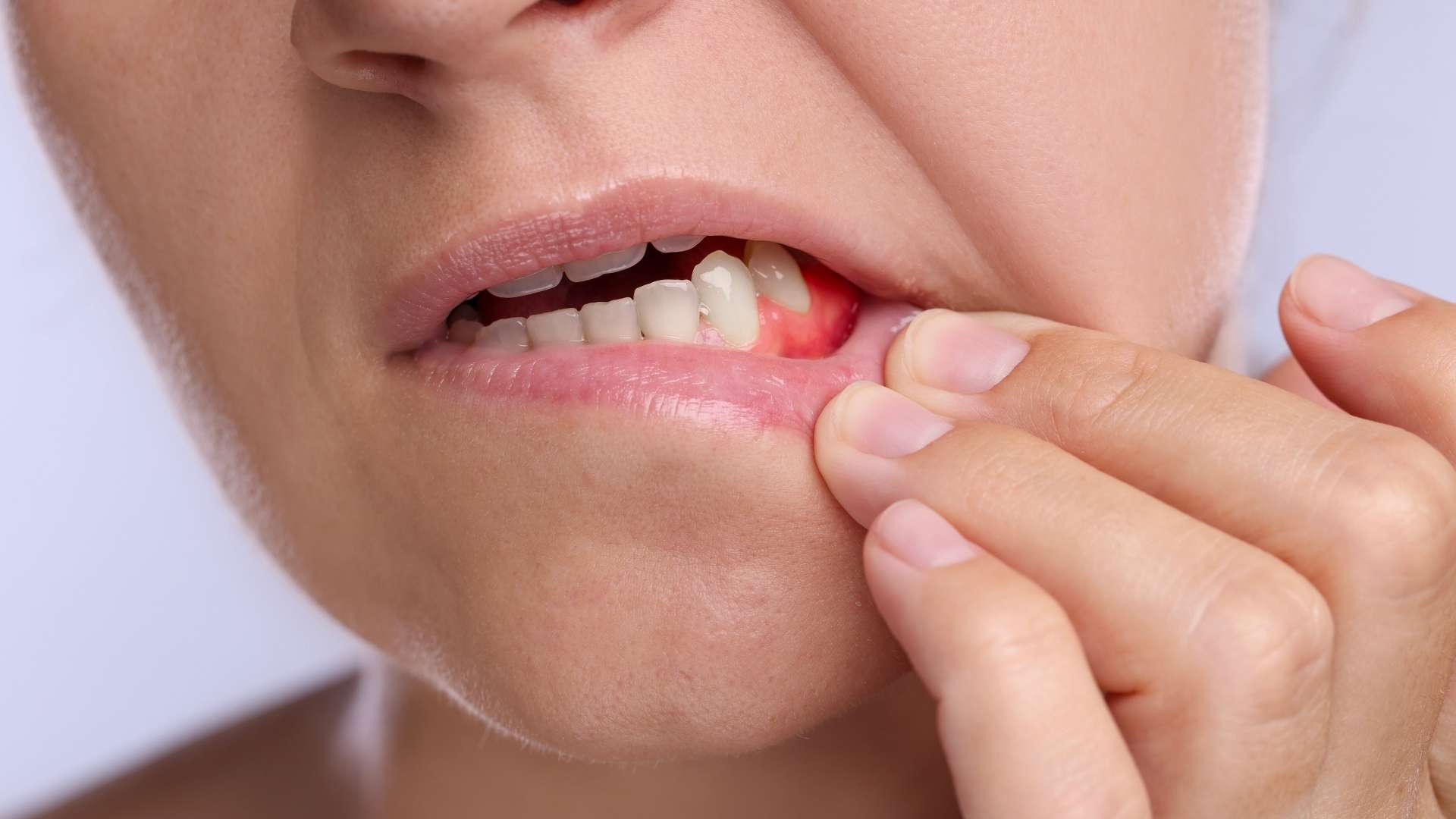 Kaplama Diş Apse Yaparsa Ne Yapılmalı?