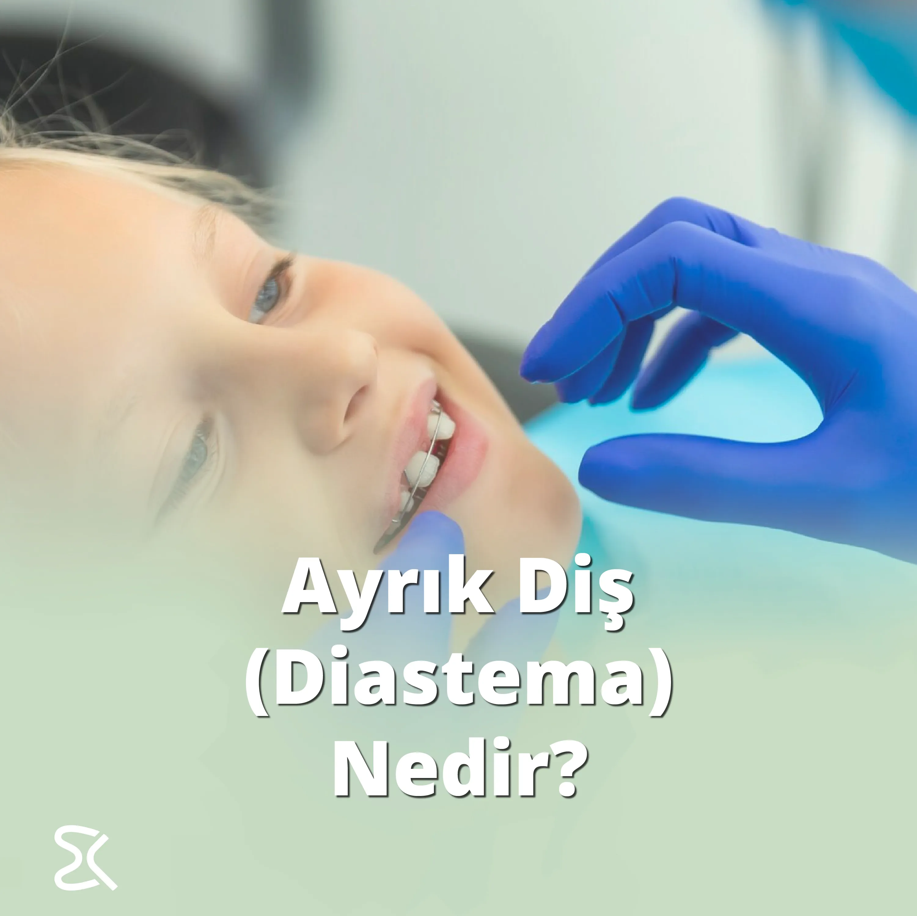 Ayrık Diş (Diastema) Nedir?