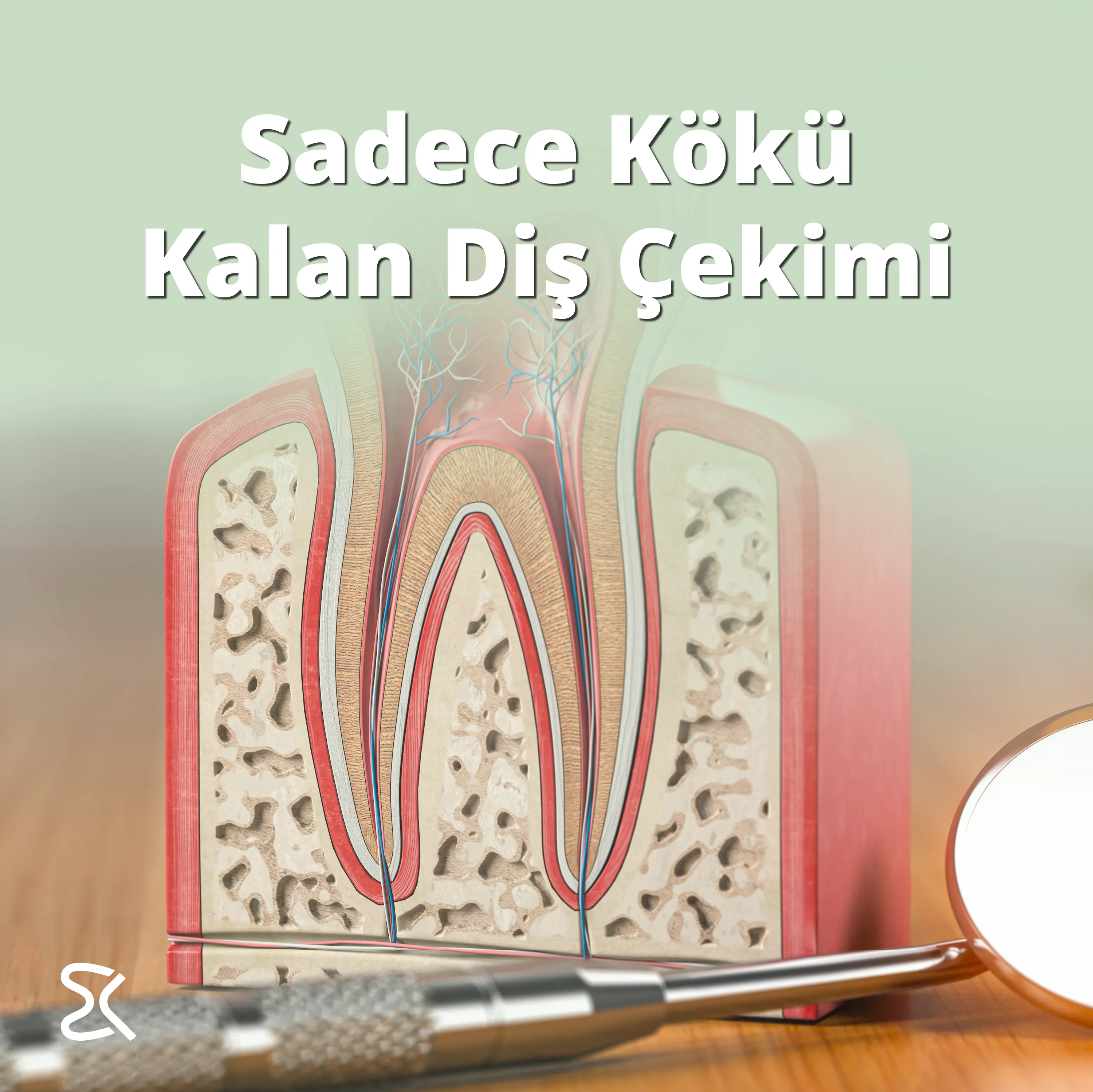 Sadece Kökü Kalan Diş Çekimi