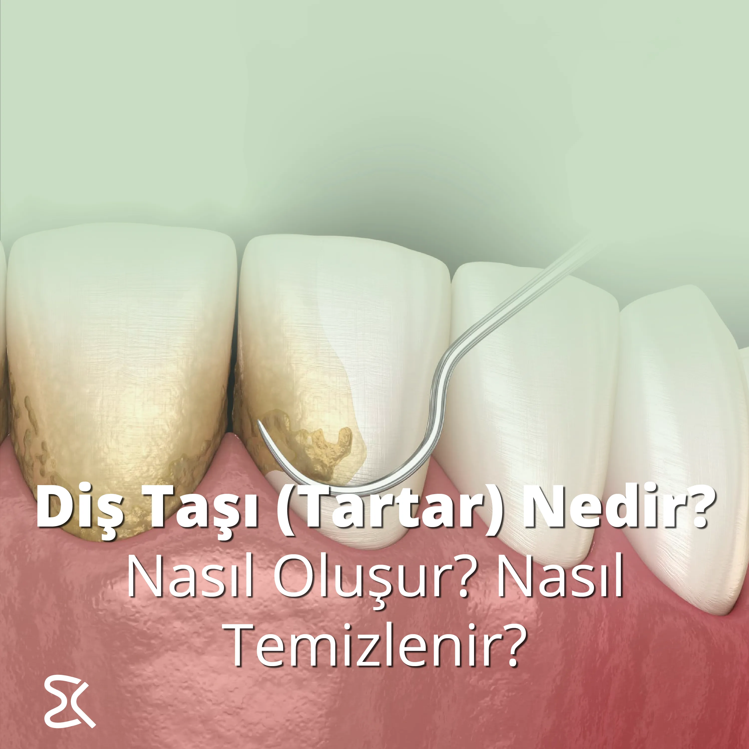 Diş Taşı (Tartar) Nedir? Nasıl Oluşur? Nasıl Temizlenir?