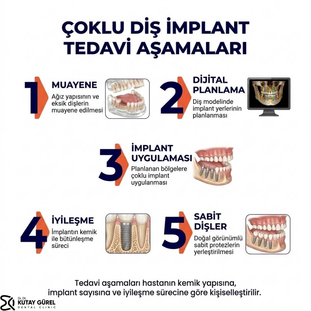 Çiğli İzmir Çoklu Diş İmplant Tedavisi Aşamaları