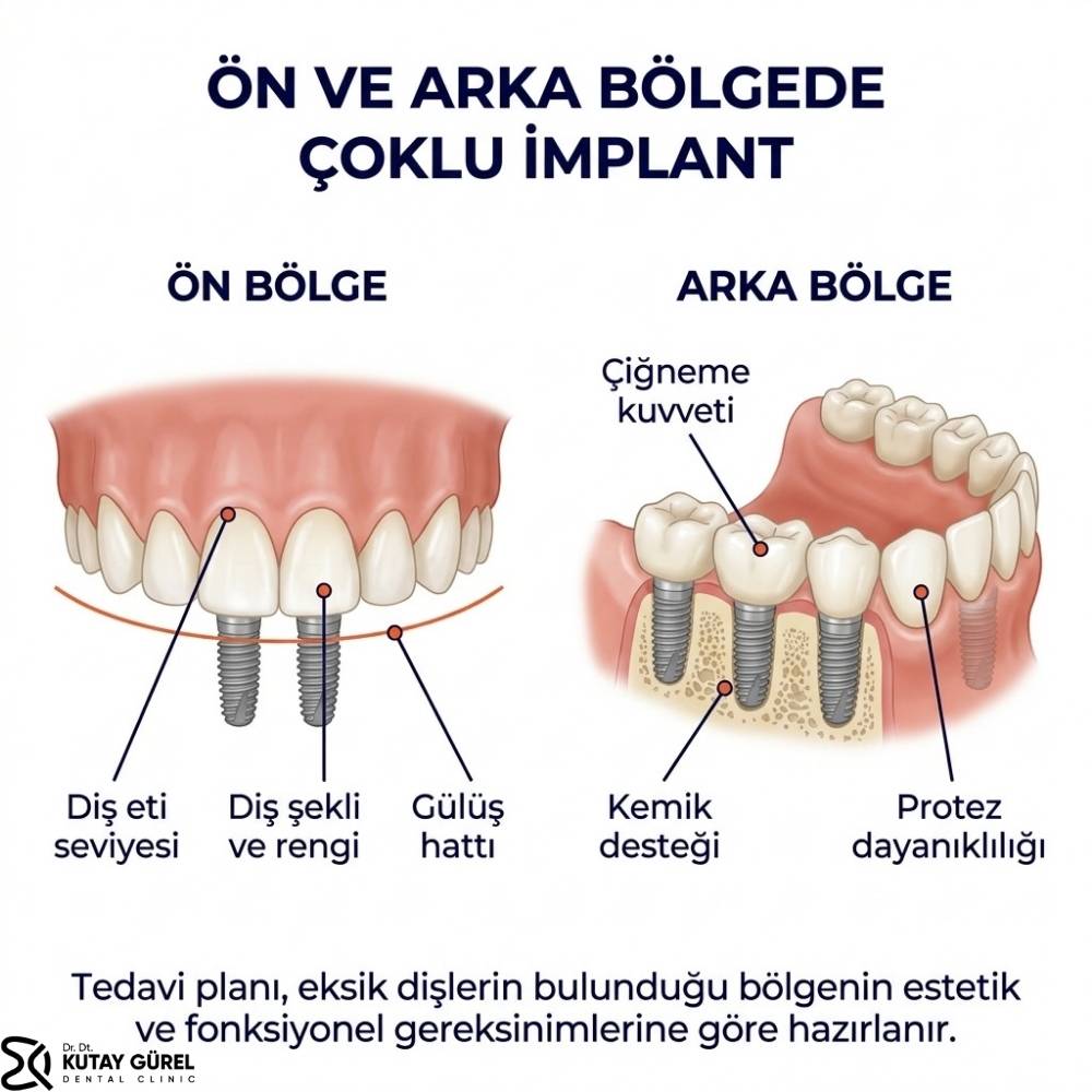 İzmir Çiğli Tüm diş implant fiyatları