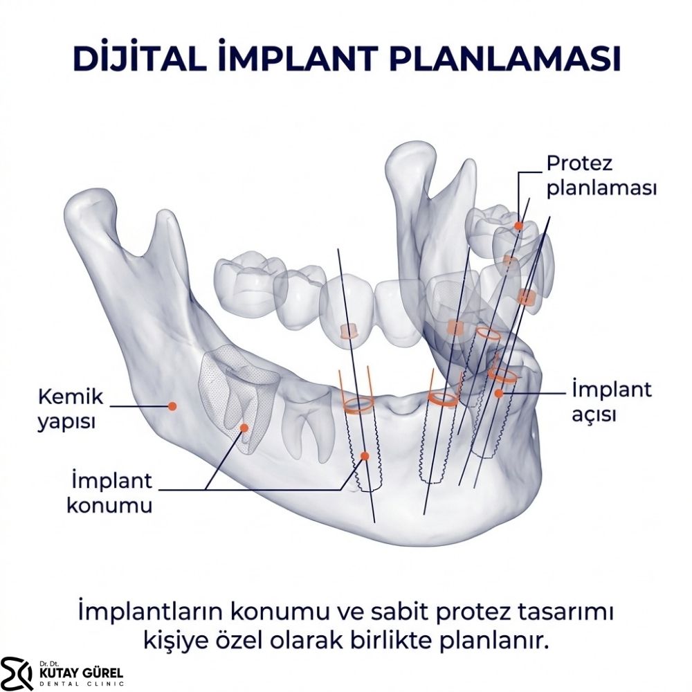 İzmir Çiğli Tüm dişleri implant yaptırmak ne kadar?