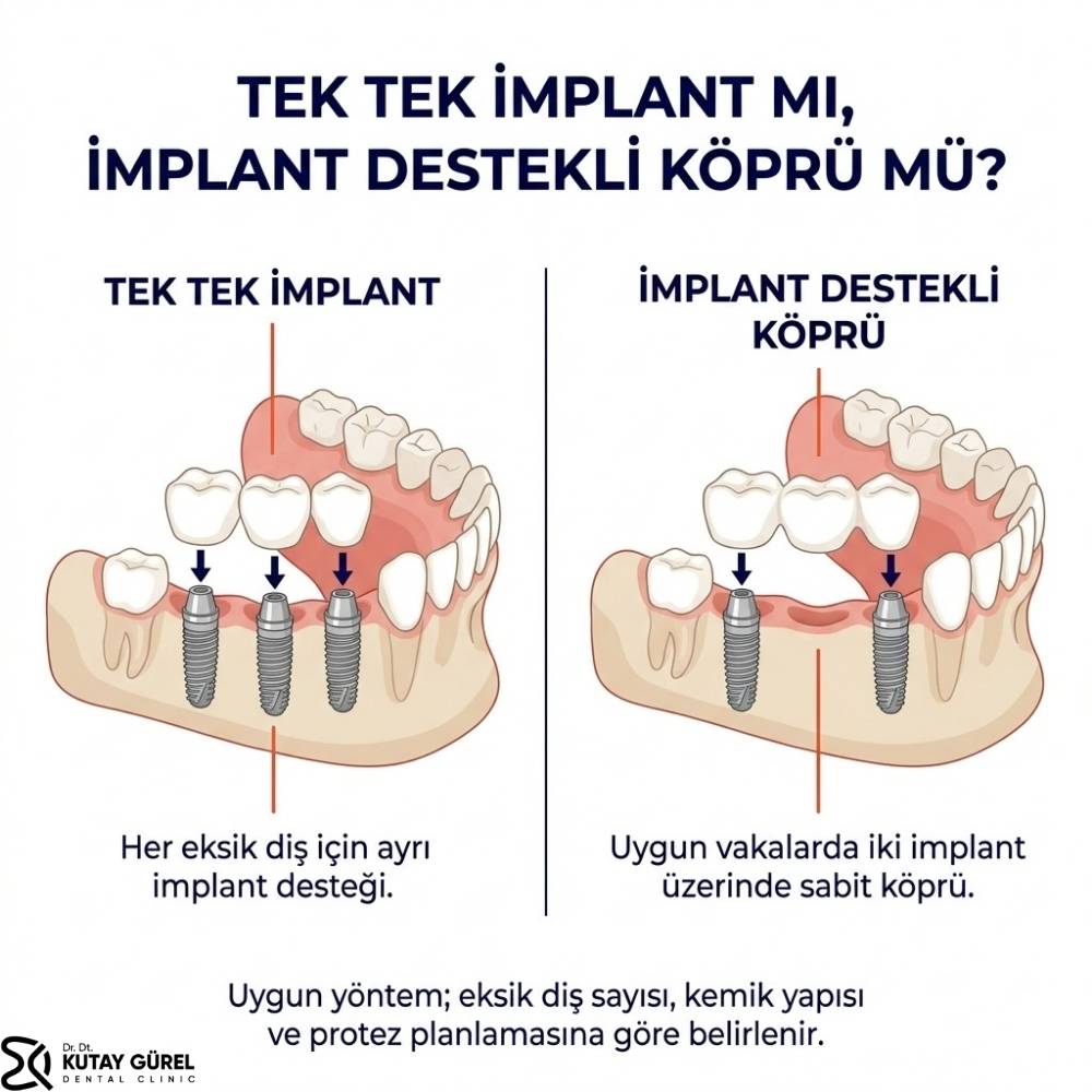 İmplant diş en fazla kaç tane yapılır