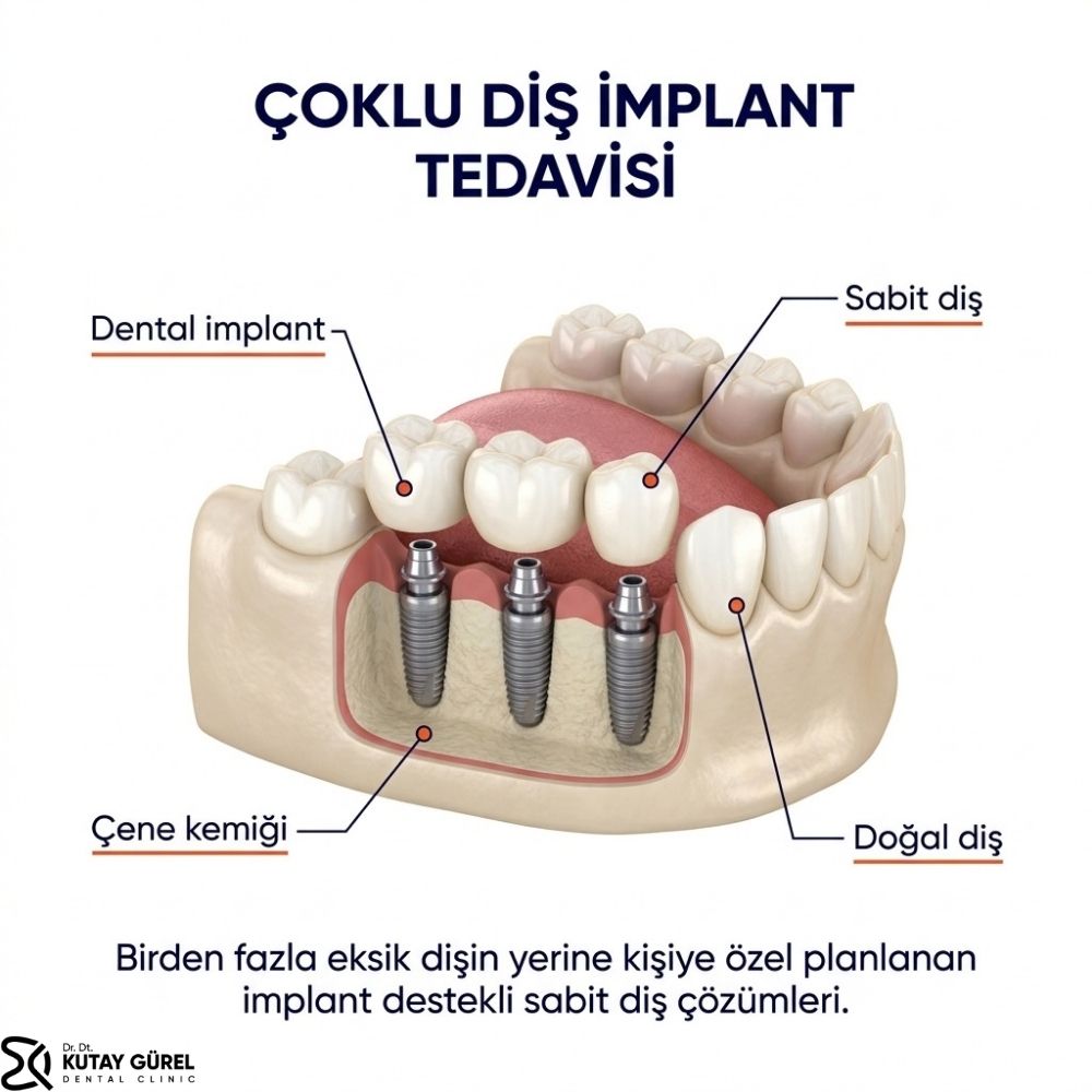 İzmir Çiğli Çoklu Diş İmplant Tedavisi