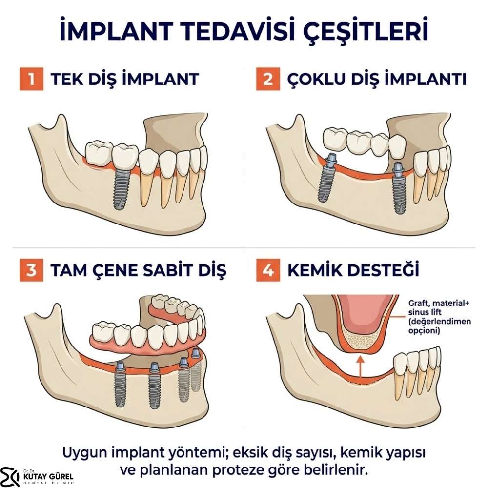 Çiğli implant tedavisi