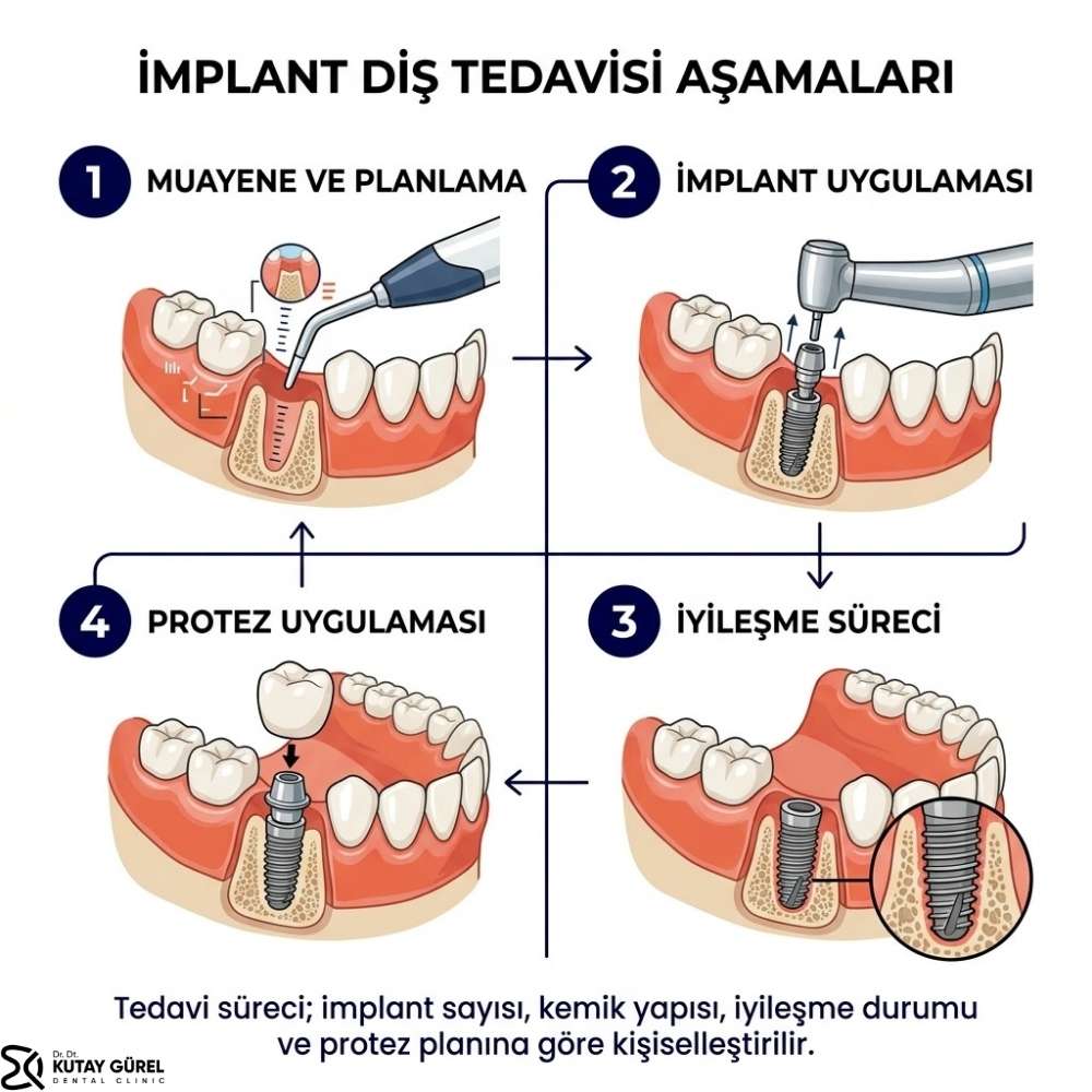 Diş implantı kimlere yapılmaz Çiğli