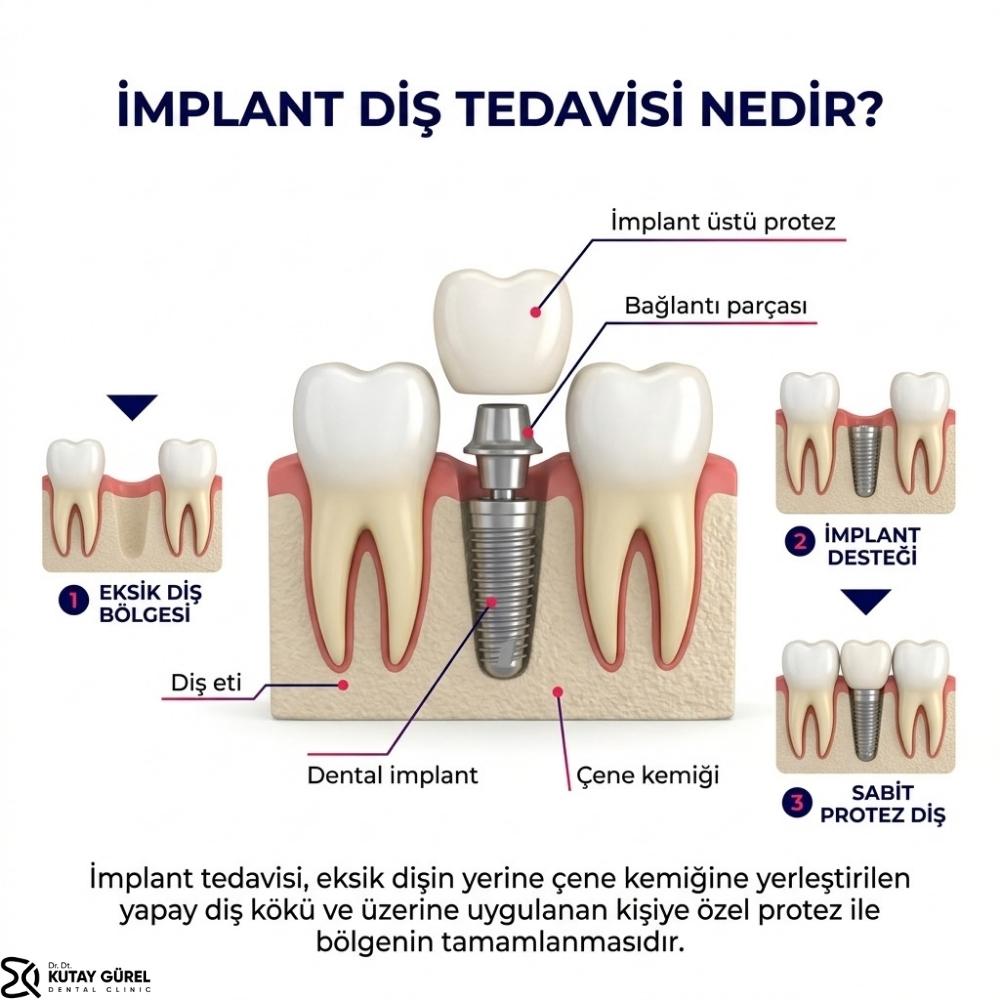 implant fiyatları izmir