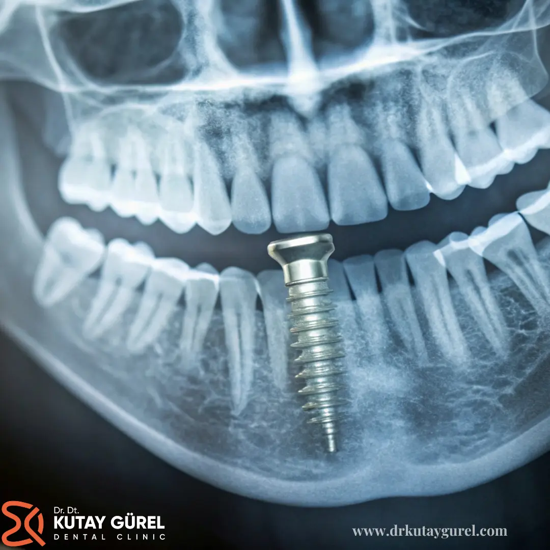 En iyi İmplant Diş Doktoru Dr. Dt. Kutay Gürel Diş Kliniği All-on-4 İmplant Tedavisi, dişsiz çenelerde dört implant ile sabit diş protezleri uygulayarak, doğal görünüm ve fonksiyonel çözüm sunar. Izmir Çiğli’de, profesyonel ekip tarafından gerçekleştirilen All-on-4 implant tedavisi, hastalarımıza kalıcı ve estetik sonuçlar elde etme imkanı sağlar.