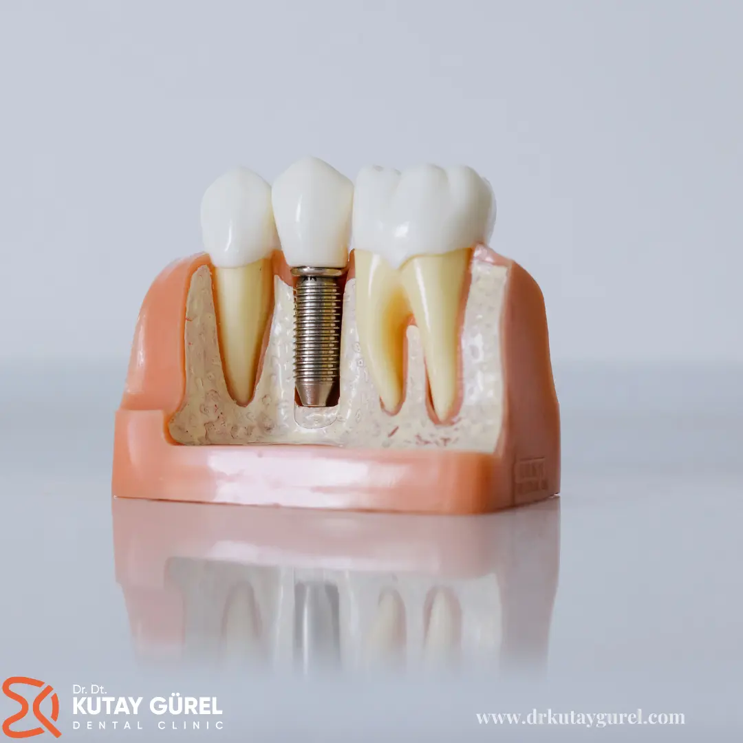İzmir Çiğli All on Sİx İmplants Diş Tedavisi, İzmir Çiğli En İyi Diş Doktoru Dr.Dt. Kutay Gürel, All-on-Six İmplants Dental, İzmir Çiğli En iyi diş doktoru
