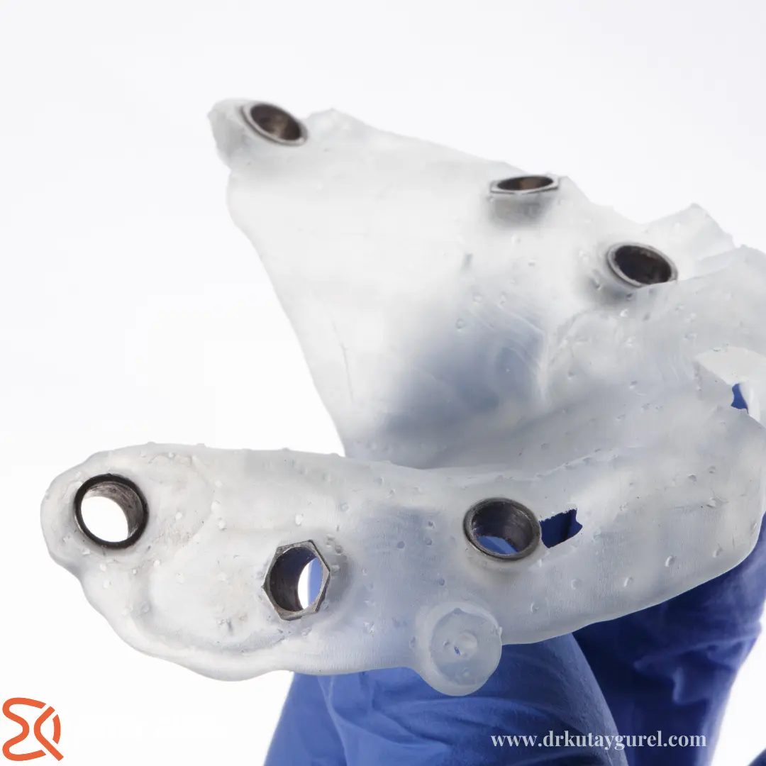 İzmir Çiğli All on Six İmplants Diş Tedavisi, All-on-Six İmplants Dental, İzmir Çiğli En iyi diş doktoru