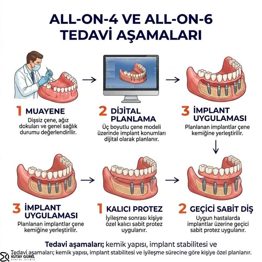 All-on-4 ve All-on-6 İmplant Tedavisi Ne Kadar Sürer