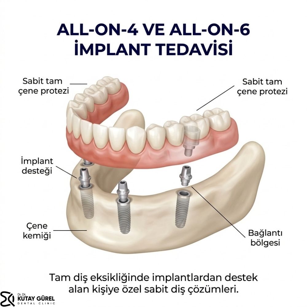 All-on-4 ve All-on-6 İmplant Tedavisi