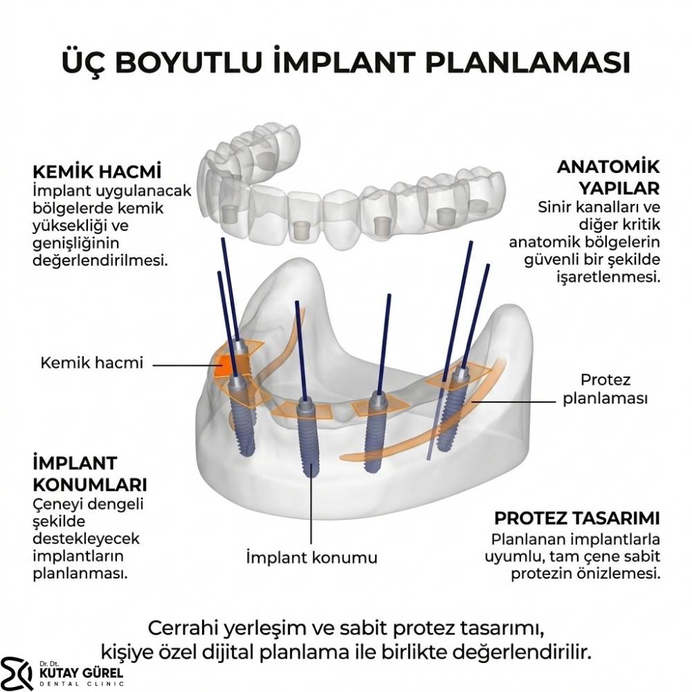 izmir çiğli all on six implant nedir