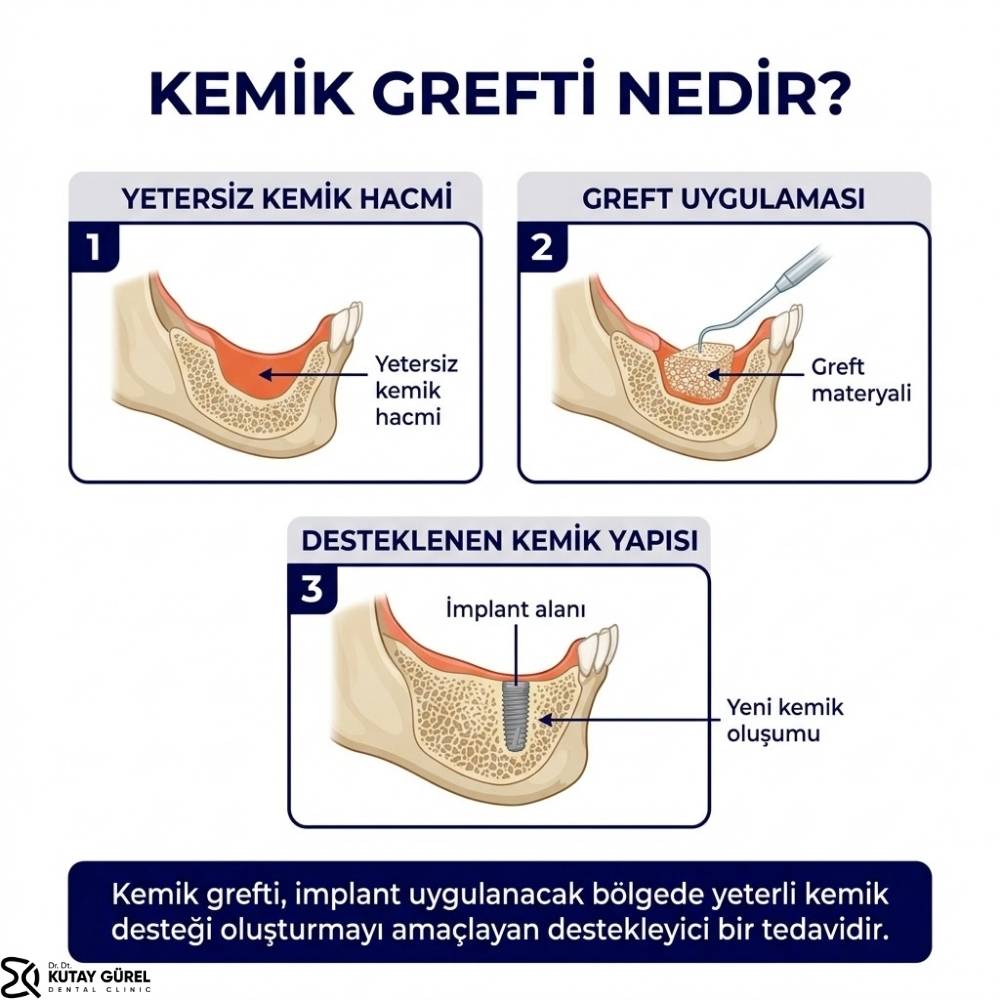 izmir Çiğli Diş implantı için sinüs kaldırma işlemi neden yapılır
