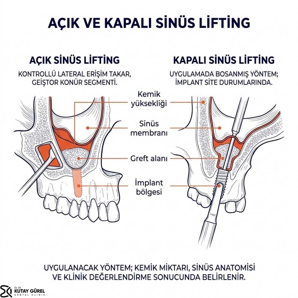 İzmir Çiğli Kemik grefti ameliyatı kaç günde iyileşir