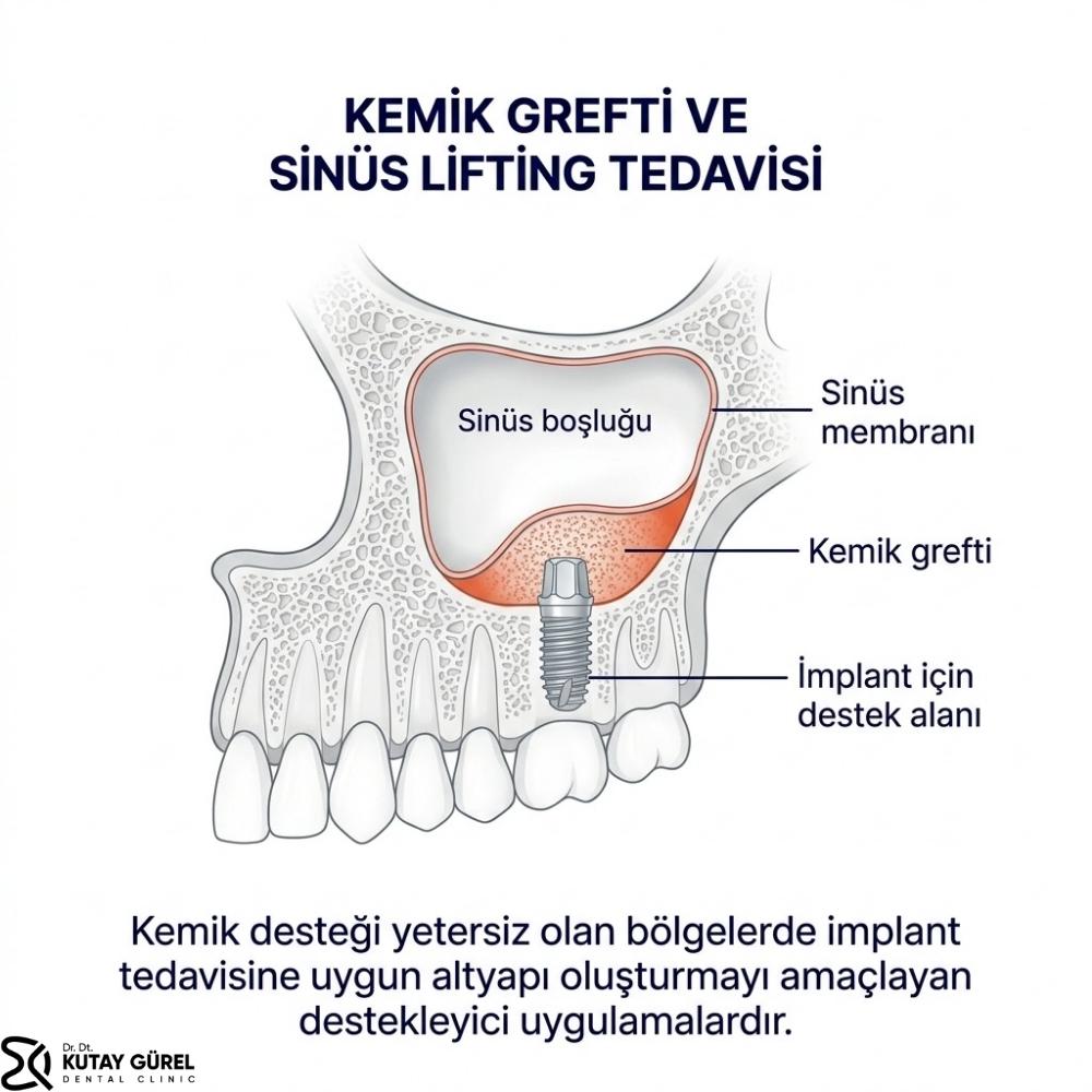 İzmir Çiğli Kemik Grefti ve Sinüs Lifting Tedavisi