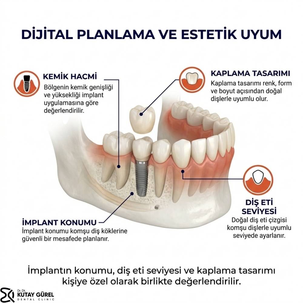 Çiğli İzmir Tek Diş İmplant Tedavisi Nasıl Yapılır