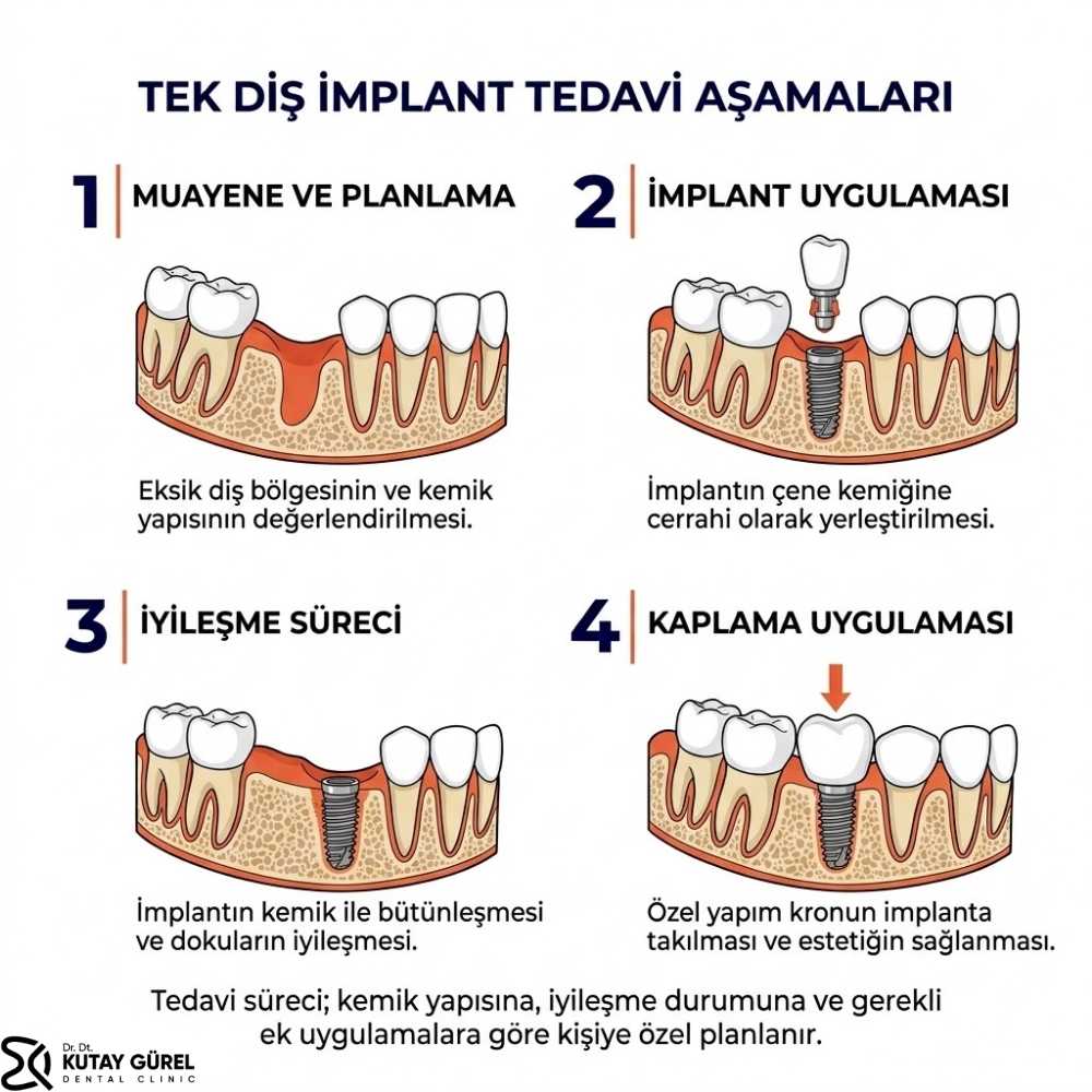 çiğli izmir tek diş implantı tedavi aşamaları