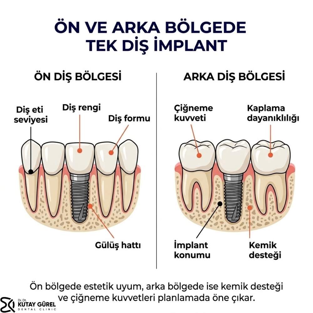 İzmir Çiğli Tek diş implant Fiyatları