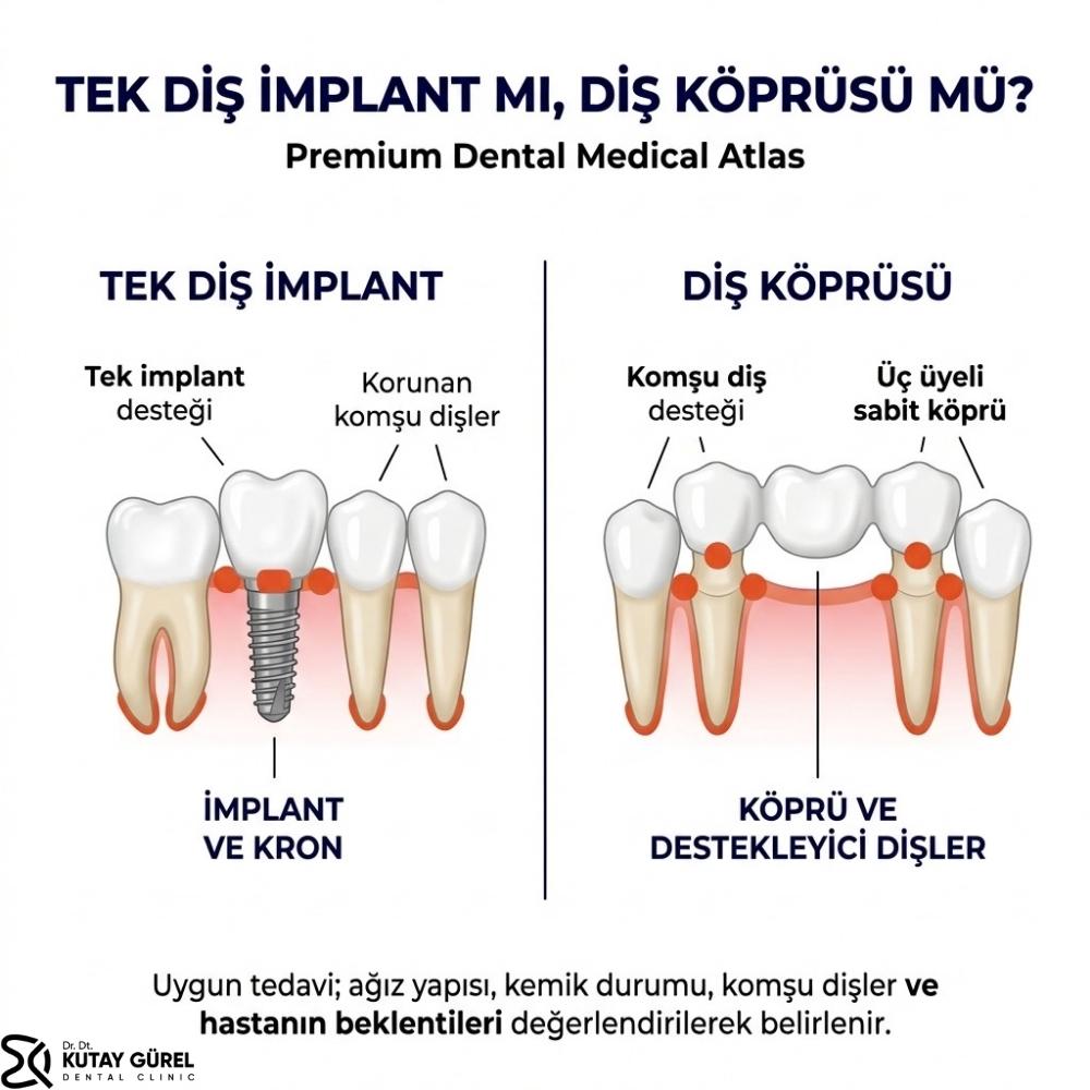 izmir çiğli Tek diş implant fiyatı
