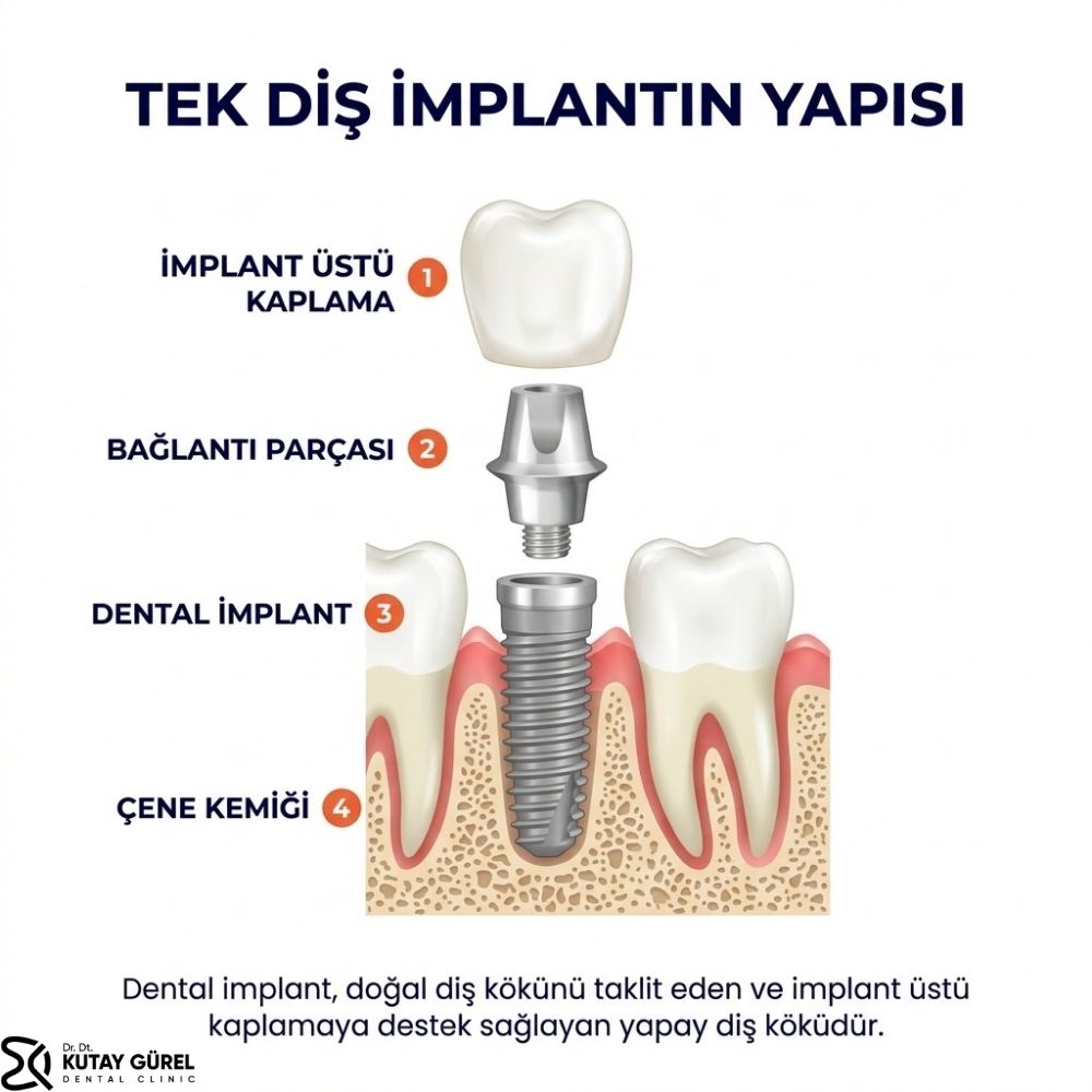 Tek diş implantı kaç günde yapılır Çiğli izmir