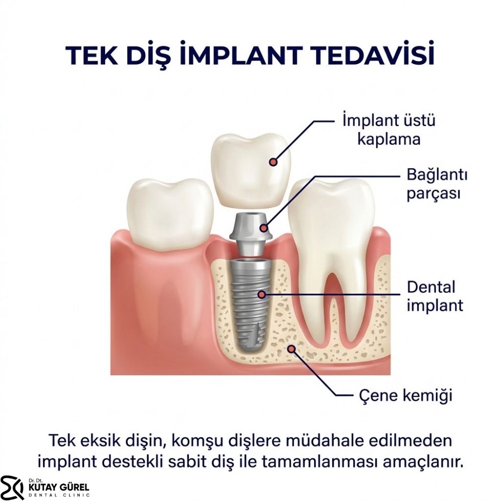 izmir Tek diş için implant yapılır mı
