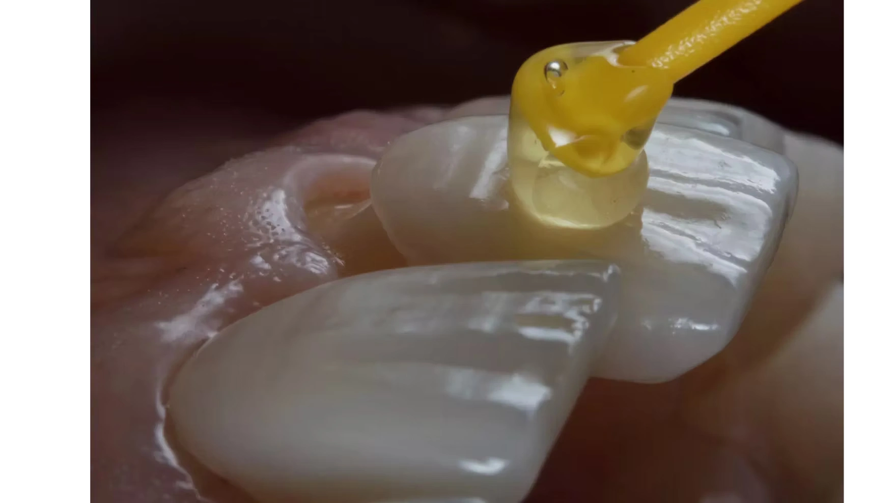 Zirkonyum Diş Kaplama Tedavisi Nasıl Yapılır izmir cigli