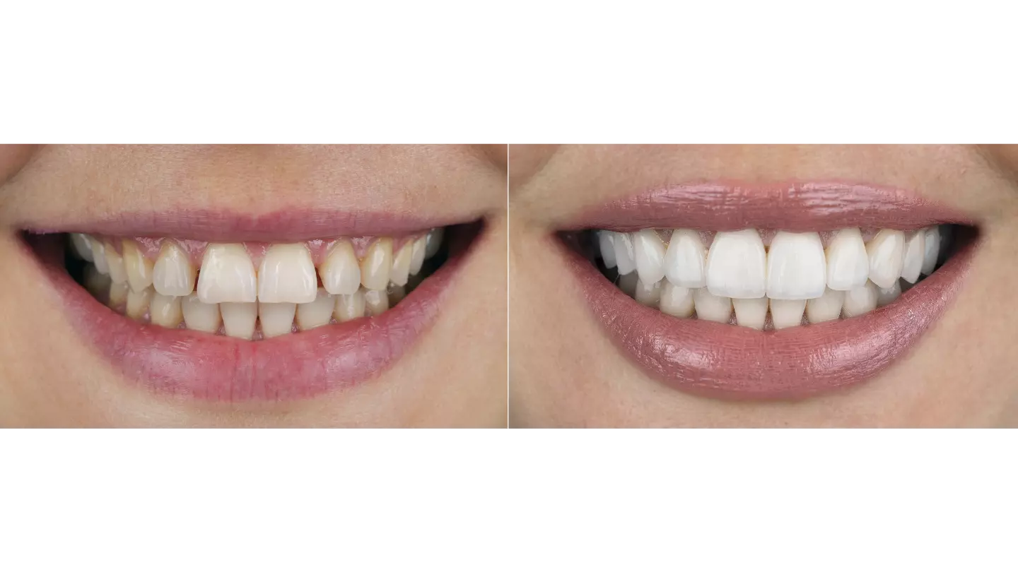 Zirkonyum Diş Kaplamaları Hangi Durumlarda izmir cigli