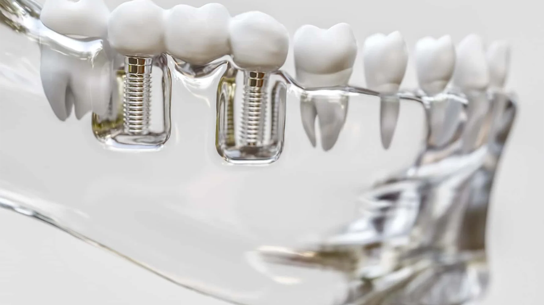 İmplant Nasıl Yapılır? izmir cigli