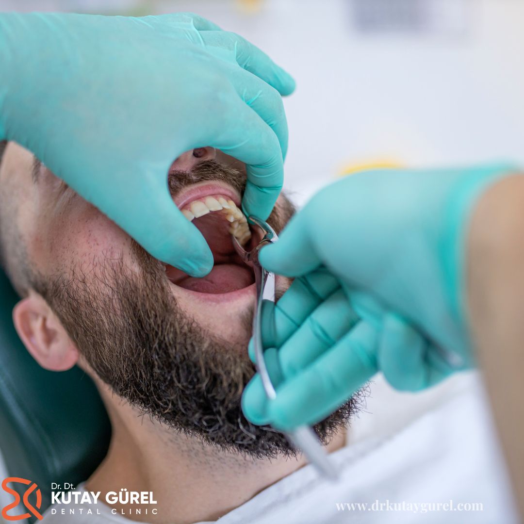 Kök Diş Çekimi Ameliyatı