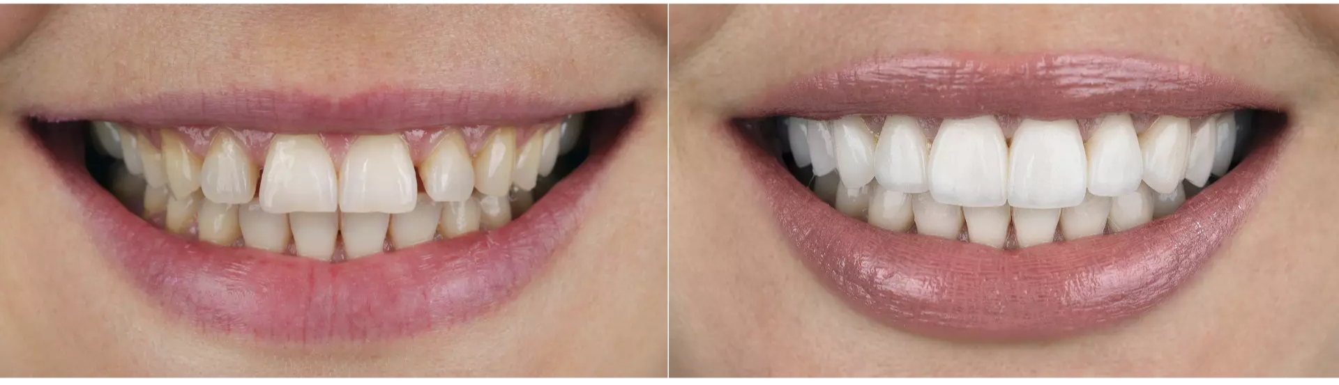 emaz diş kaplama izmir cigli